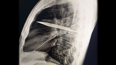 Diagnostic dilemma: A knife broke off in a man's chest, and he didn't notice it for 8 years