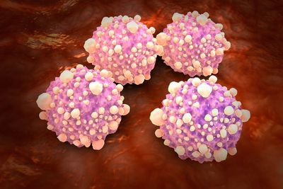 Mouth bacteria may increase pancreatic cancer risk threefold, experts say