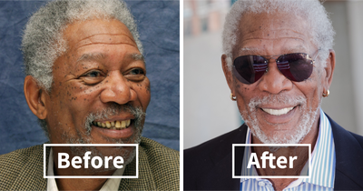 Veneers Before And After: Photos Of 15 Celebrities With The Most Dramatic Smile Makeover