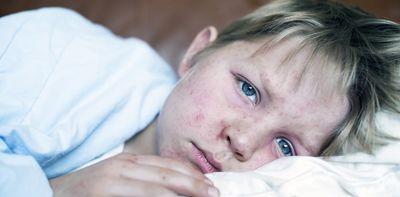 New measles cases in Queensland show ‘herd immunity’ is more important than ever