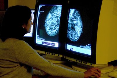 Women who miss first breast cancer appointment have ‘40% higher risk of death’