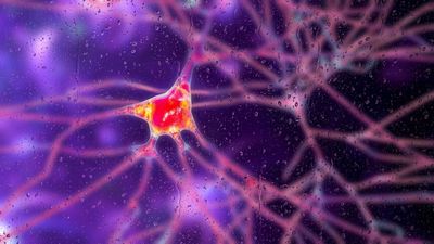 'Groundbreaking' gene therapy is first treatment for Huntington's disease to slow the condition