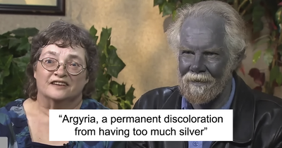 42 Rare Diseases That Sound Like A Science Fiction Plot But Are 100% Real