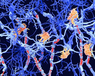 ‘Exciting’ clinical results offer hope for new class of MS therapies