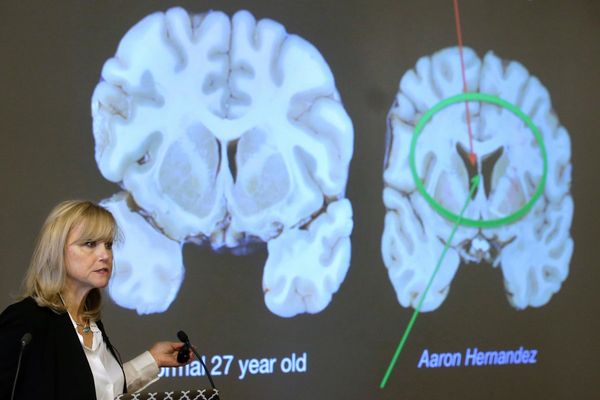 Here's what to know about CTE, the brain disease the NYC shooter blamed for his mental health issues