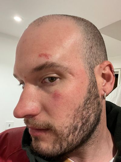 Lime faces compensation claims from cyclists 'badly injured falling from firm's e-bikes in London'