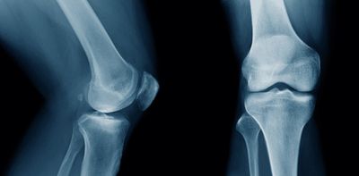 Medical Miracle? New 'Bone Glue' Heals Fractures in Minutes, not Months – And the Body Absorbs It Naturally