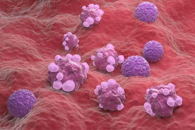 NHS hospital becomes first to offer new ovarian cancer surveillance test