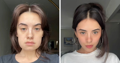 Woman’s ‘Kybella’ Face Transformation Stuns People After Her Extreme Recovery Phase Goes Viral