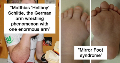 74 Photos Of Human Body Quirks That Are Both Fascinating And Shocking