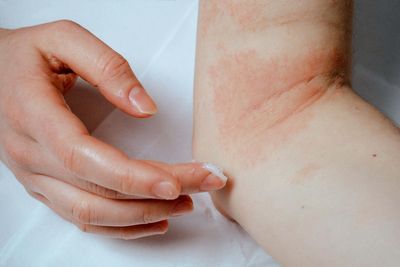 New eczema tool could benefit millions of patients