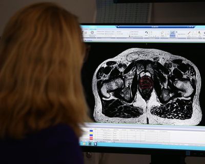 More than 60,000 cancer patients in England ‘not getting necessary radiotherapy’