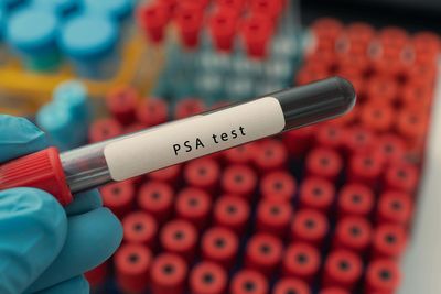 Most men ‘would attend a prostate cancer screening programme’ – poll