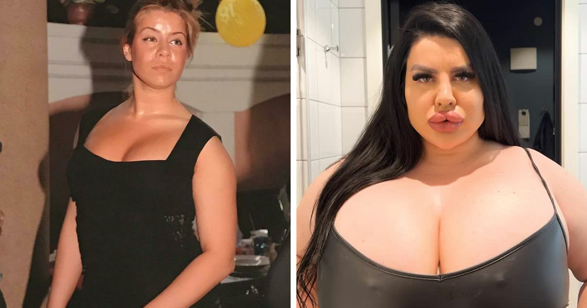 Plastic Surgery Enthusiast Who Paid $148k For 5 BBLs…
