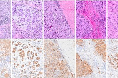 Groundbreaking ‘super vaccine’ could stop cancer from spreading entirely