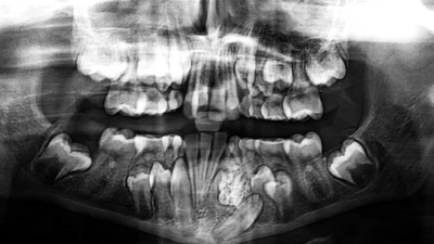 17yo goes to hospital for jaw pain, dentist takes out a chisel to remove 232 teeth