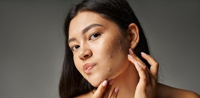 Acne: a GP’s guide to understanding and managing it