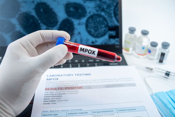 Two monkeypox cases in California under investigation