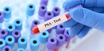 Should the UK introduce targeted prostate cancer screening? The case for and against