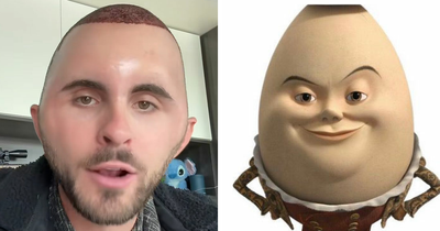 “I Literally Look Like An Egg”: TikToker’s Hair Transplant Recovery Has Everyone Cracking Up