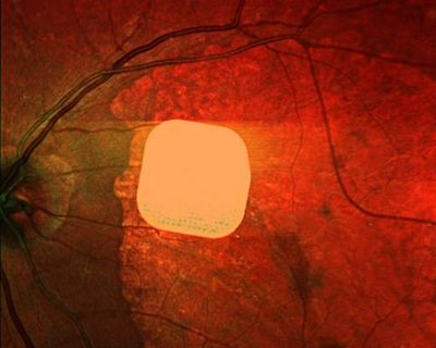 Experts hail ‘remarkable’ success of electronic implant in restoring sight
