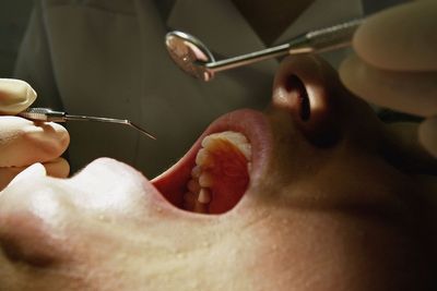 Scientists warn of surprising link between dental health and stroke risk