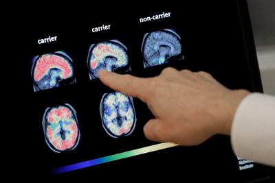 Scientists on cusp of ‘very early’ dementia diagnosis after breakthrough