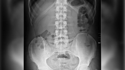 82 yo woman enters the hospital complaining of stomach pain. What doctors found was a rare miracle