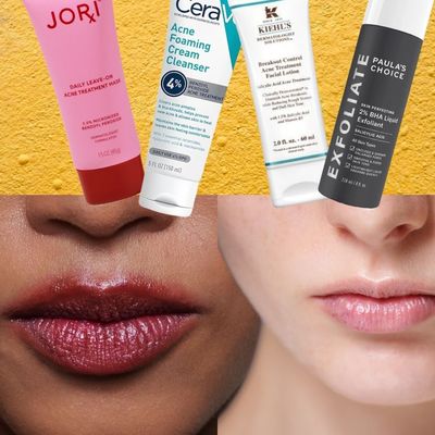 How to Treat Hormonal Acne Like a Pro, According to a Dermatologist