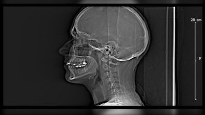 64yo Miami photographer underwent surgery to end his pain, instead a toxic chemical was injected into his spine