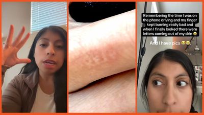 Woman experiences burning and finds weird letters have appeared on her fingers, but TikTok can’t work out what it says