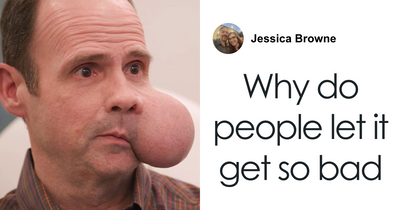 After Man Waits 7 Years To Remove 4-Lb. Face Tumor, Doctor Gives Him Fatal Warning