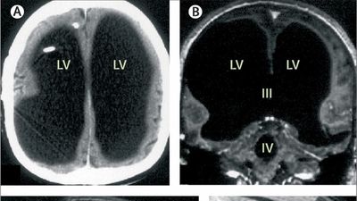 44yo man visited hospital after feeling a weakness in his leg. Doctors ran tests only to find he was missing 90% of his brain