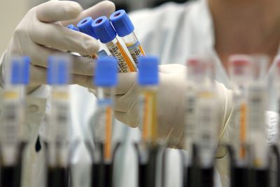 AI study aims to transform prostate cancer treatment