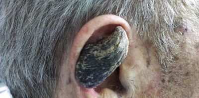 Why some humans grow horns