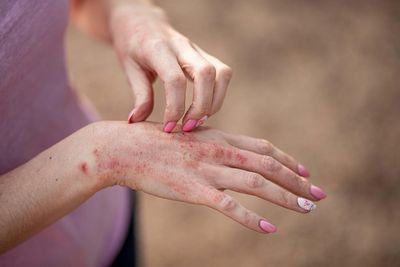 NHS rollout of new eczema cream could benefit more than 62,000 people in England