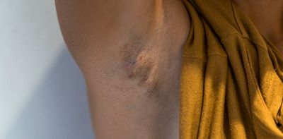 Hidradenitis suppurativa: the painful skin condition that can hide in plain sight