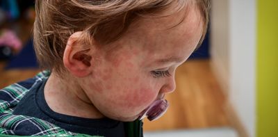 Canada loses its official ‘measles-free’ status – and the US will follow soon, as vaccination rates fall