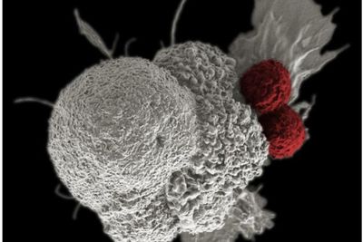 Common virus found in most people can trigger lupus, study reveals