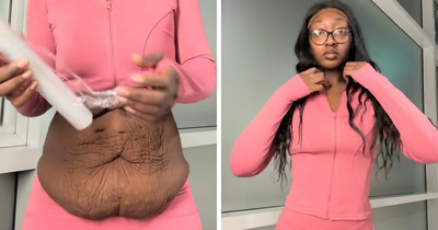 Woman’s Trick To Hide Loose Skin On Her Belly After Massive Weight Loss Stuns People