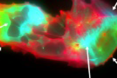 Strange changes found in blood of long Covid patients