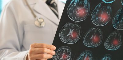 How stem cell therapy can regenerate brain tissue after a stroke