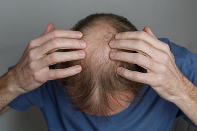 8 Reasons You’re Losing Your Hair And What You Can Do About It