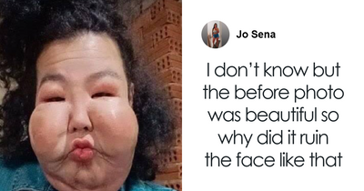 Influencer Stuns Fans With Surgery Update After Botched Procedure Leaves Her Unable To Find Work