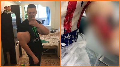 ‘These are my treasures’: The ‘Russian Popeye’ bodybuilder shows off what doctors pulled from his infected arms
