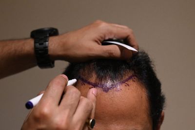 Single stressful event enough to trigger recurring hair loss, study suggests
