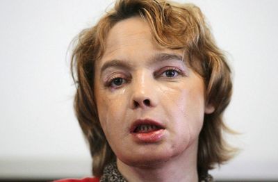Face transplants promised hope. Patients were put through the unthinkable