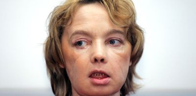 A stranger’s face? The unresolved questions of face transplantation 20 years on