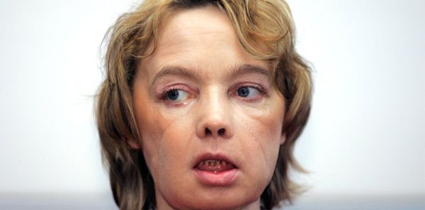 A stranger’s face? The unresolved questions of face transplantation 20 years on