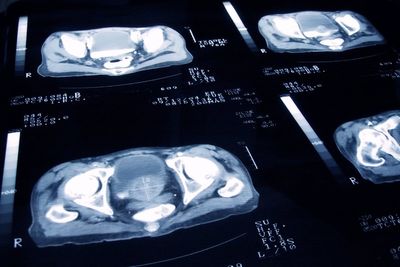 Widespread prostate cancer screening could soon become a reality